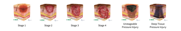 Stages of pressure injuries in patients at risk